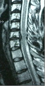 NMR: Dieser Vorfall zwischen 6. und 7. Halswirbel drückt aufs Rückenmark !