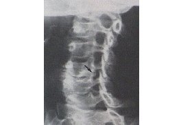 Röntgen: Einengung der Wurzelkanäle durch Knochensporne